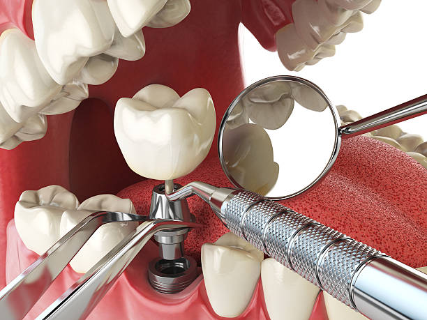 Best Emergency Tooth Extraction in Lake Landor, VA